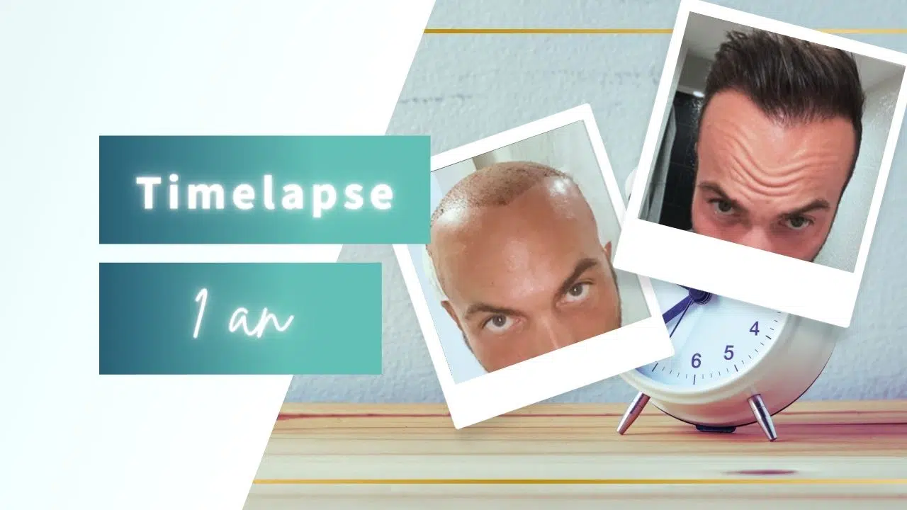 Vidéo Timelapse 1 an greffe de cheveux klineva