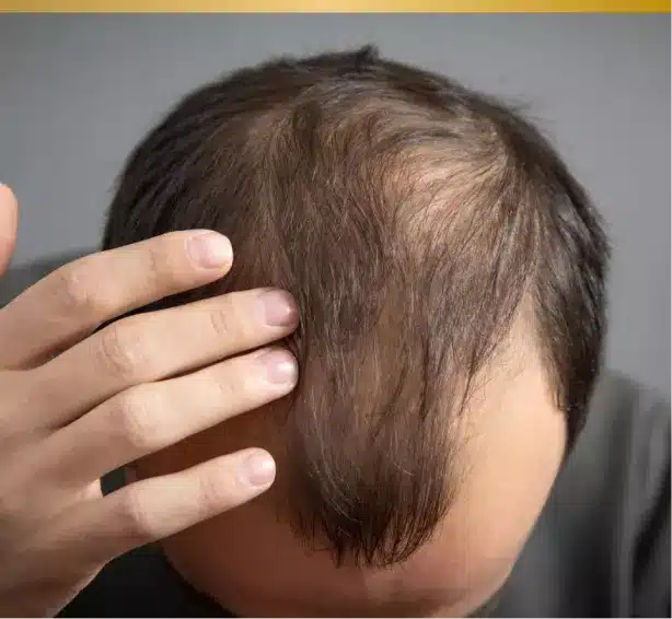 problème de calvitie homme