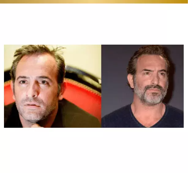 greffe cheveux Jean Dujardin