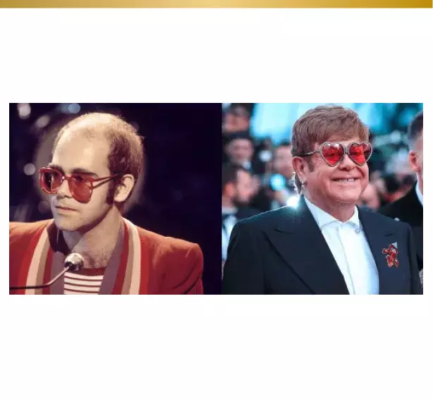 greffe cheveux Elton John