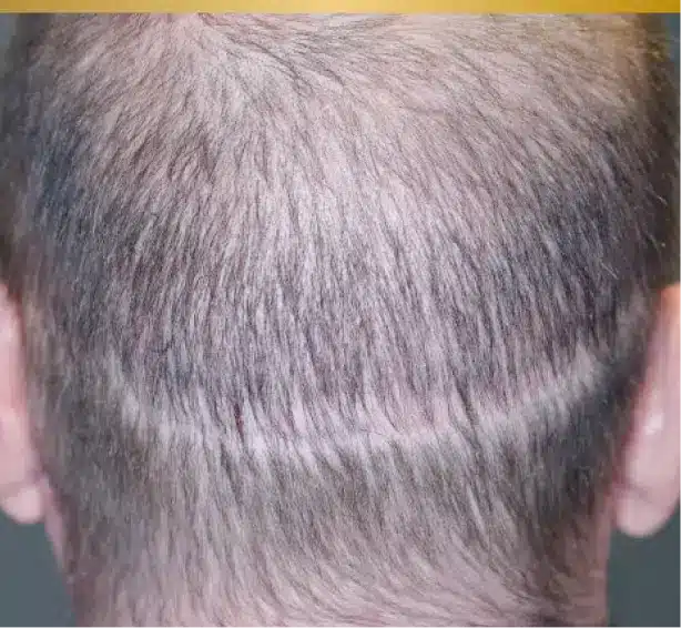 greffe cheveux Fut cicatrice