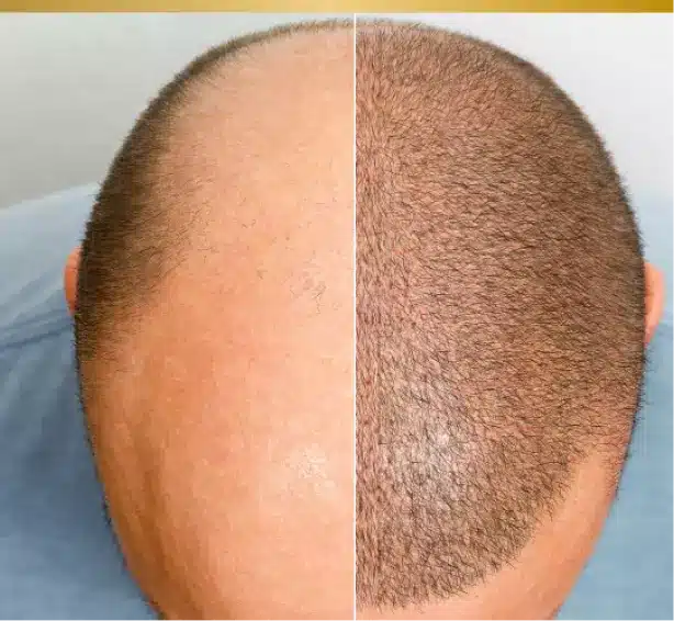 greffe de cheveux transformation