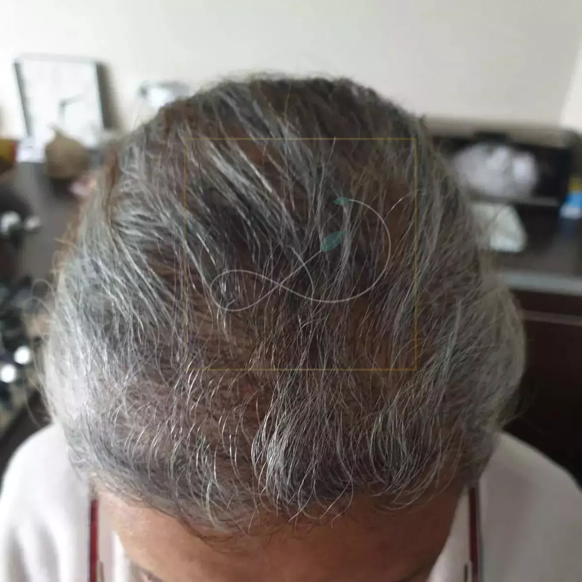 résultats après 6 mois greffe cheveux sans rasage femme