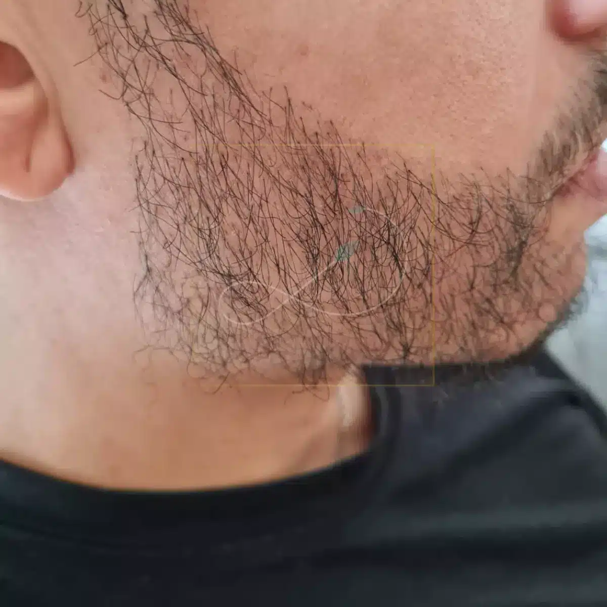 greffe de barbe DHI 2 mois