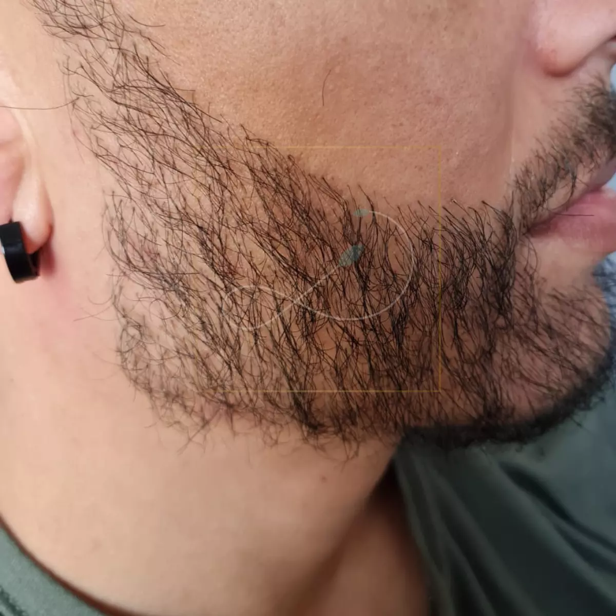 greffe de barbe DHI 3 mois
