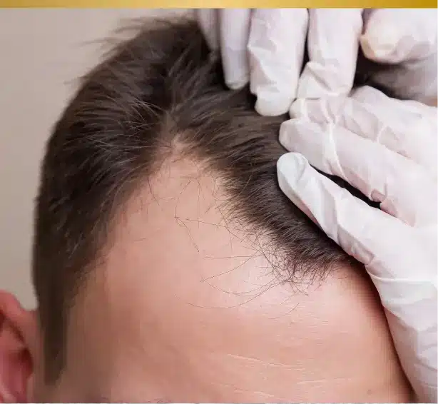 greffe de cheveux et carrière professionnel